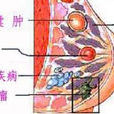 乳房腫瘤