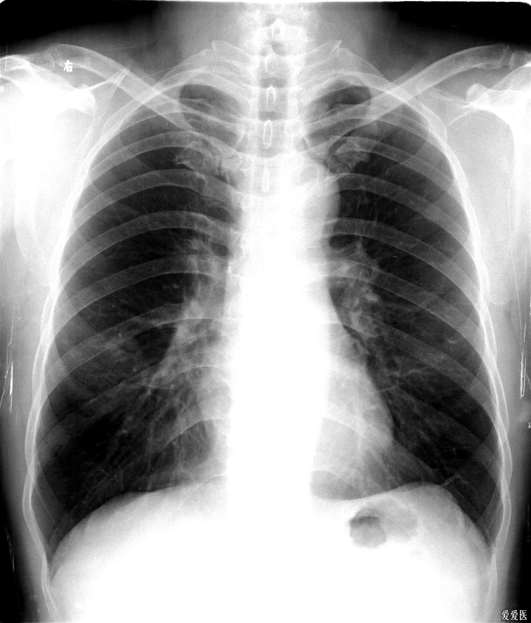 右肺中葉綜合徵