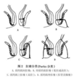 單純性肛瘺