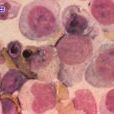 巨幼紅細胞性貧血