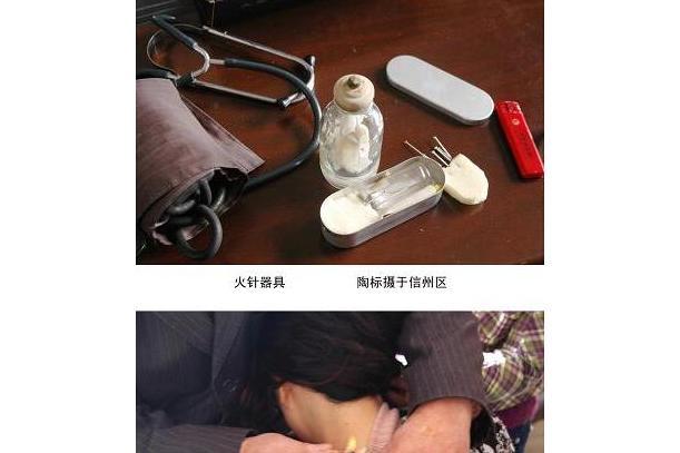 信州火針 信州火針