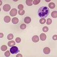 先天性紅血球紫質缺乏症