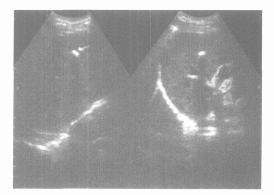 圖 2 肝內鈣化灶聲像圖