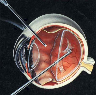眼球破裂的二期玻璃體手術