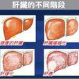 慢性B型肝炎 慢性B型肝炎