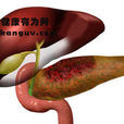 胰腺分裂症 胰腺分裂症