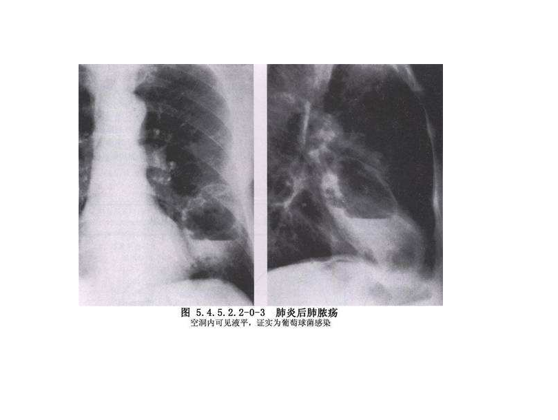肺膿瘍 肺膿瘍