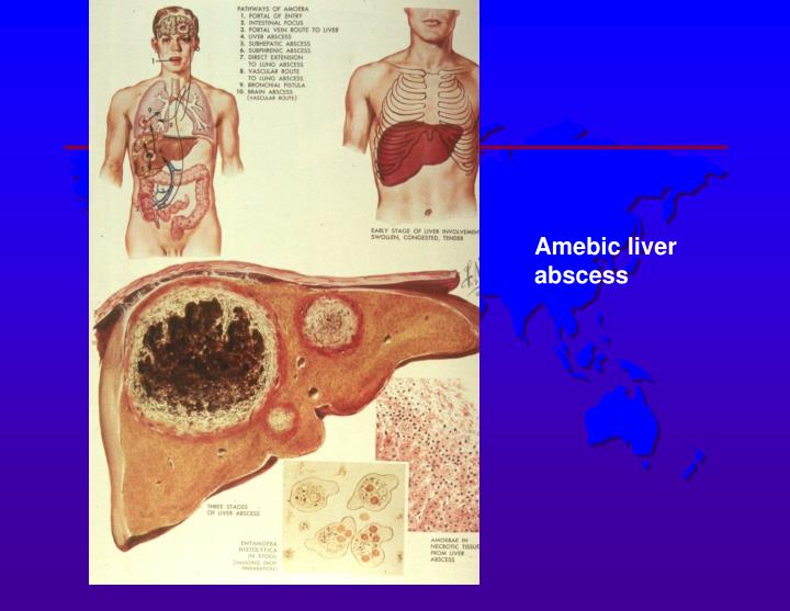 阿米巴性肝膿腫