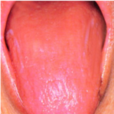 萎縮性舌炎