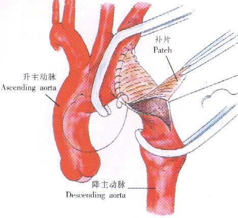 心肌補片 心肌補片
