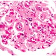 薄基底膜腎病 薄基底膜腎病