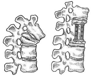 人工椎體