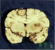 阿米巴性腦膿腫