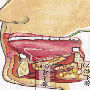 頜下腺導管結石