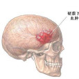 三叉神經瘤
