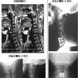 盤源性腰痛