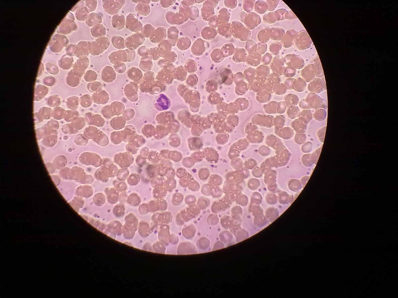 尿紅細胞形態分析