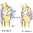風濕型關節炎