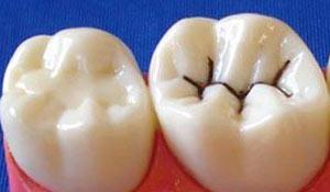 大牙凹凸不平的窩溝