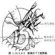 冠狀靜脈與下腔靜脈搭橋分流術