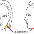 咬肌切除