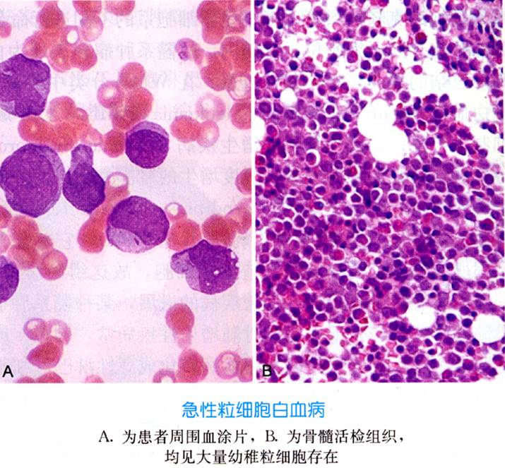 急性髓性白血病