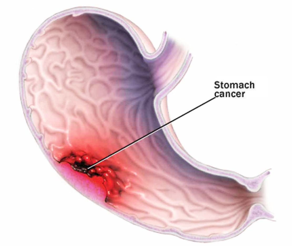 胃腫瘤