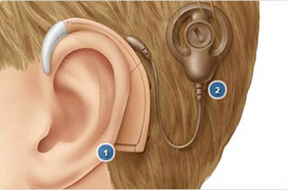 電子耳蝸植入術