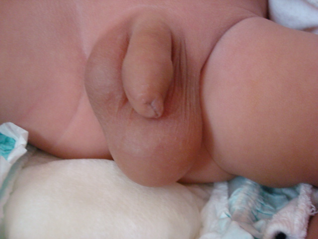 小兒睪丸鞘膜積液
