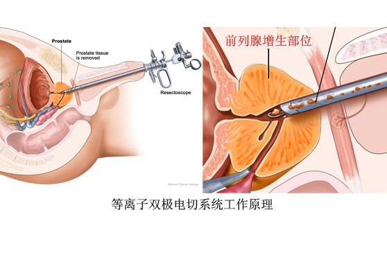 經尿道前列腺電切術