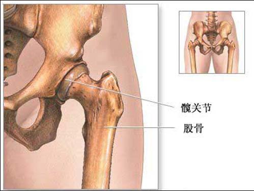 小兒股骨頭壞死