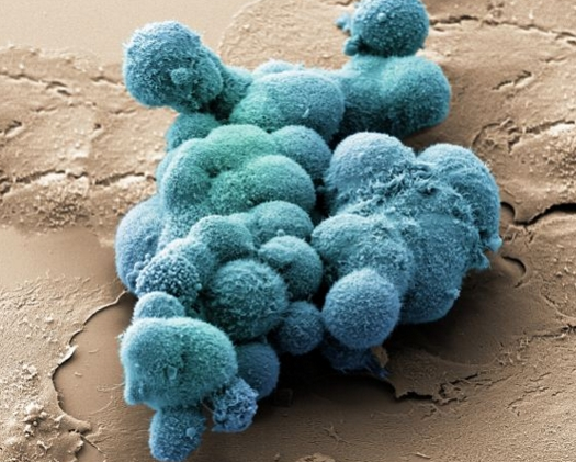 胰腺癌細胞
