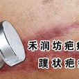 蹼狀疤痕 蹼狀疤痕
