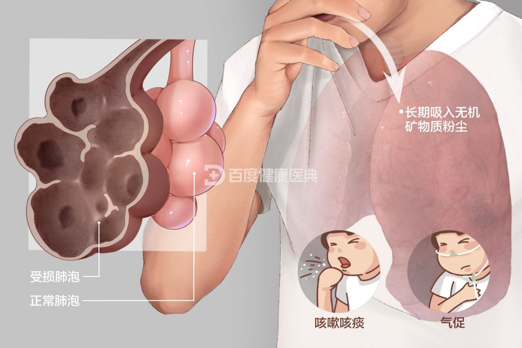 肺塵埃沉著病(矽肺)