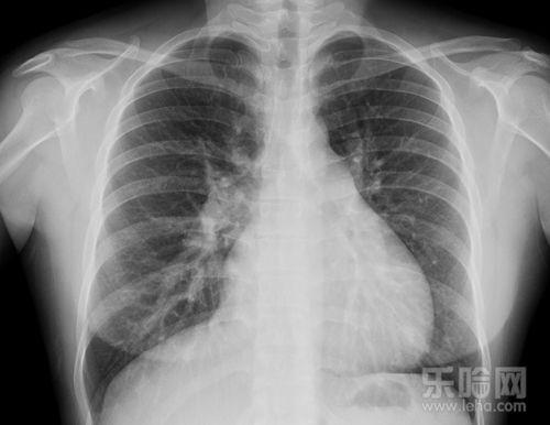 肺紋理