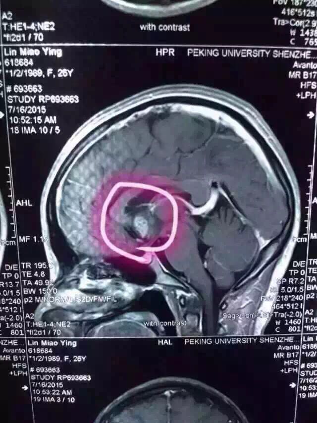 腦部腫瘤