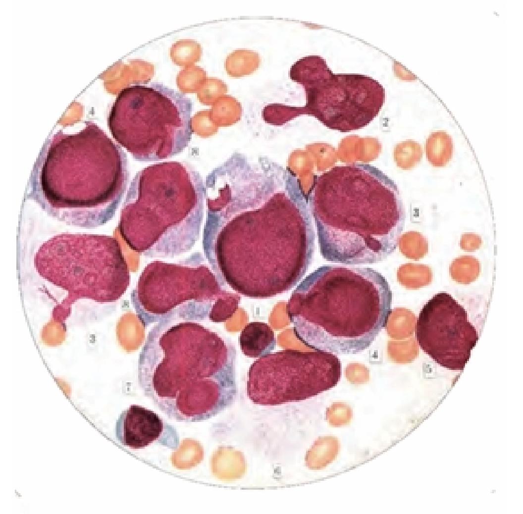 急性單核細胞性白血病