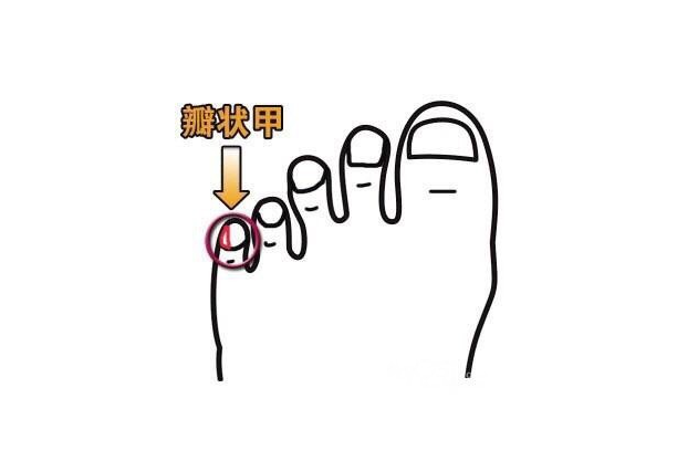 跰趾(復趾) 跰趾(復趾)