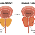 前列腺(攝護腺) 前列腺(攝護腺)