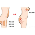 自體脂肪隆胸