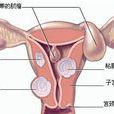 宮頸腫瘤 宮頸腫瘤