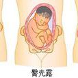 臀產式 臀產式