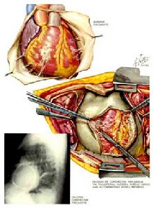 心臟手術剖析圖