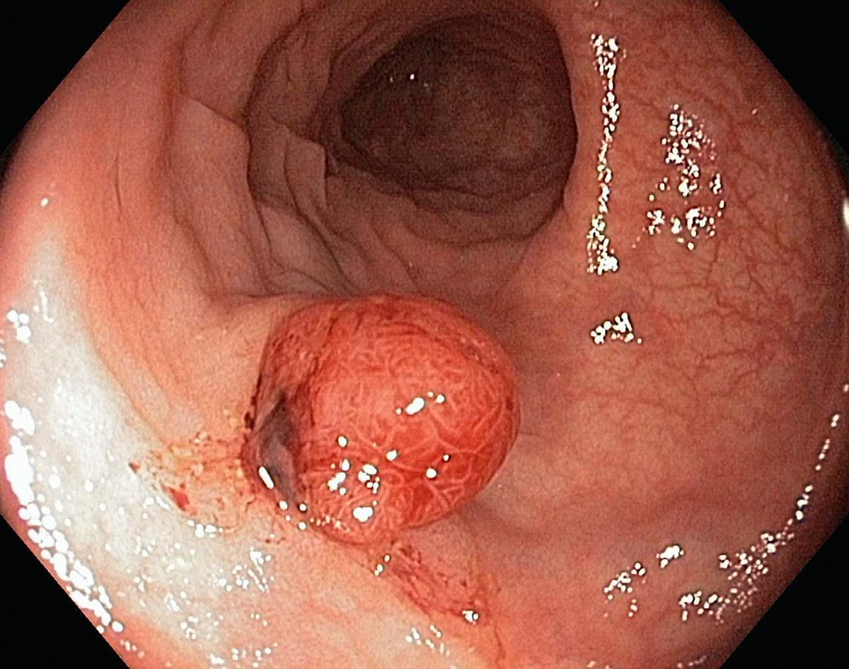 乙狀結腸息肉