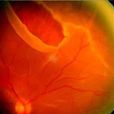 視網膜裂孔