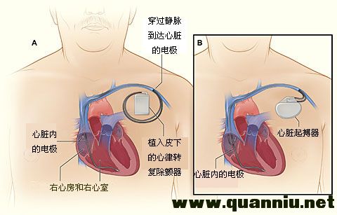 心律轉復除顫器與心臟起搏器的比較