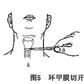 喉插管損傷 喉插管損傷