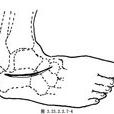 三關節固定術 三關節固定術