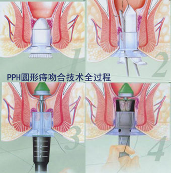 PPH手術過程