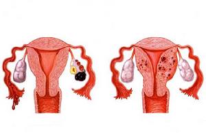 女性生殖器官結核